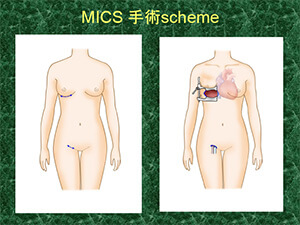 MICS pscheme